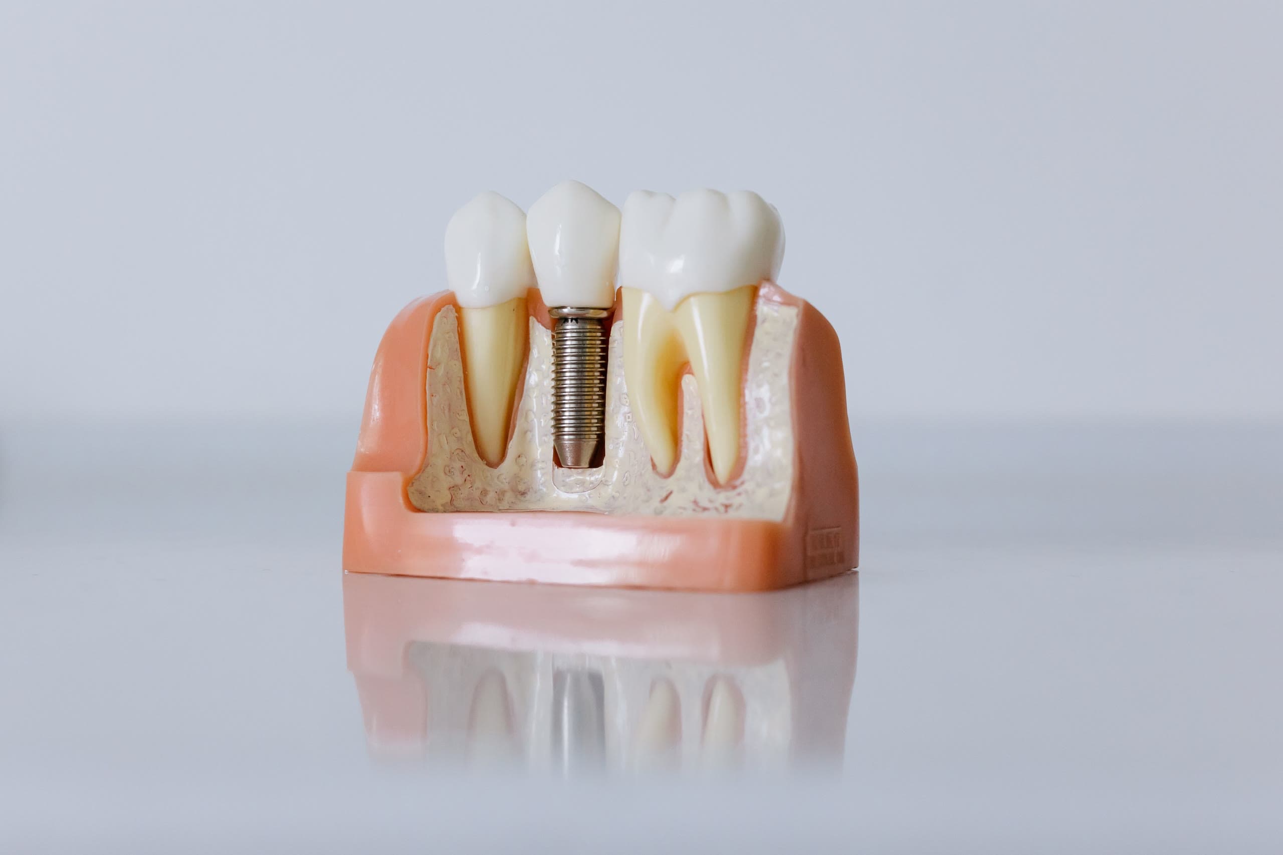Modello dimostrativo con un impianto inserito nell'osso fra due denti naturali