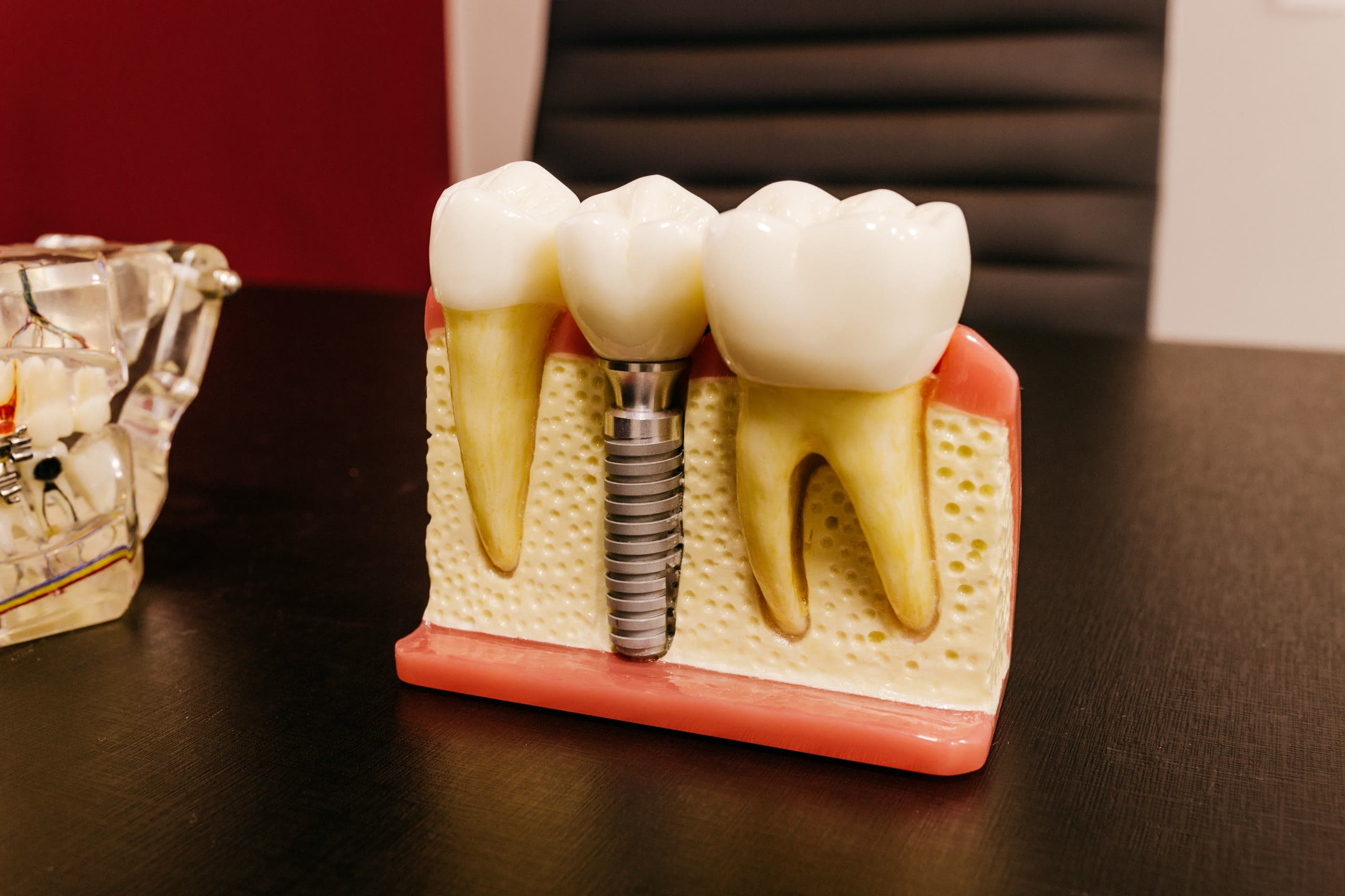 Modello anatomico sezionato: la vite implantare in titanio avvitata nell’osso fra due denti naturali