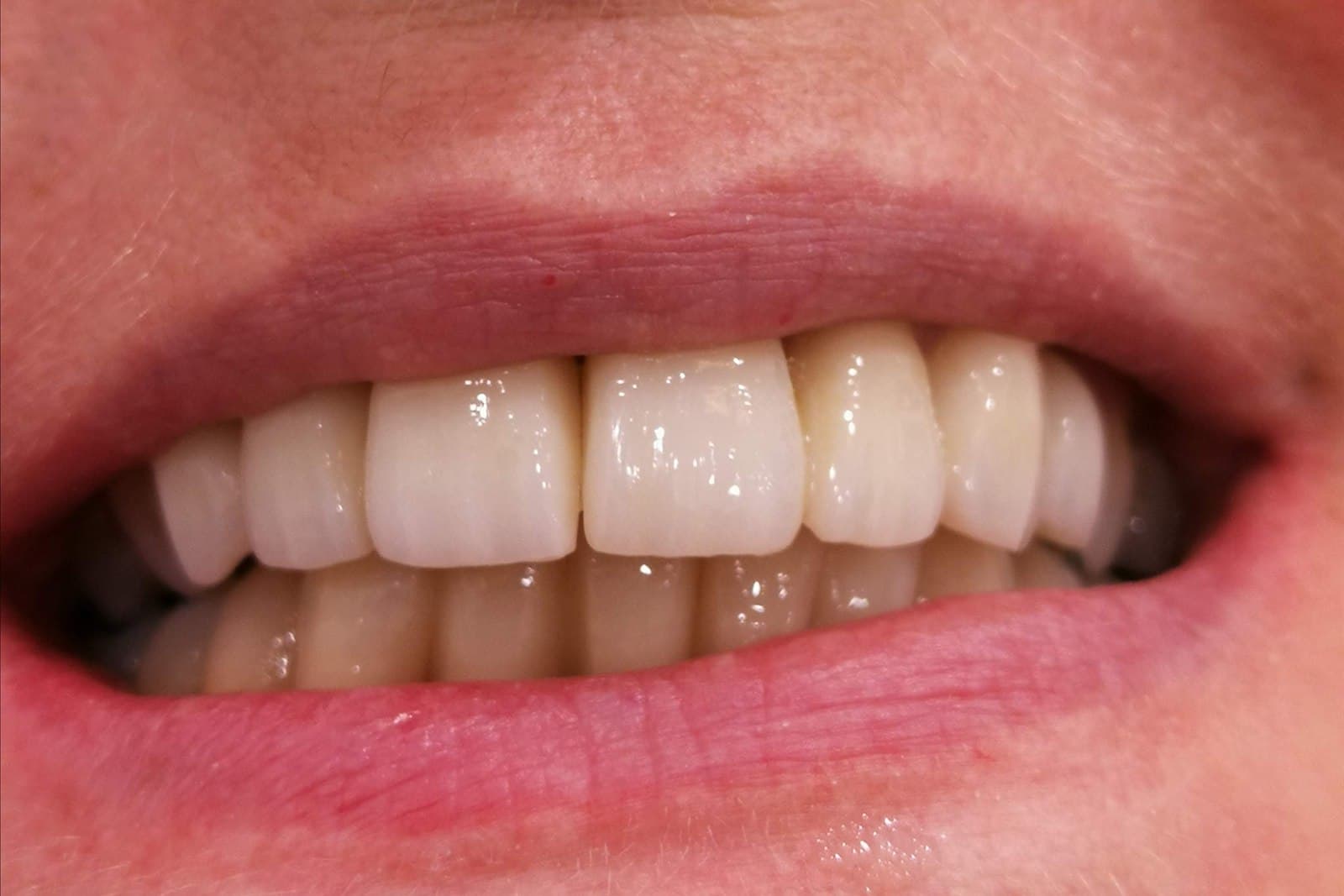 Lo stesso sorriso al termine del trattamento — caso 1