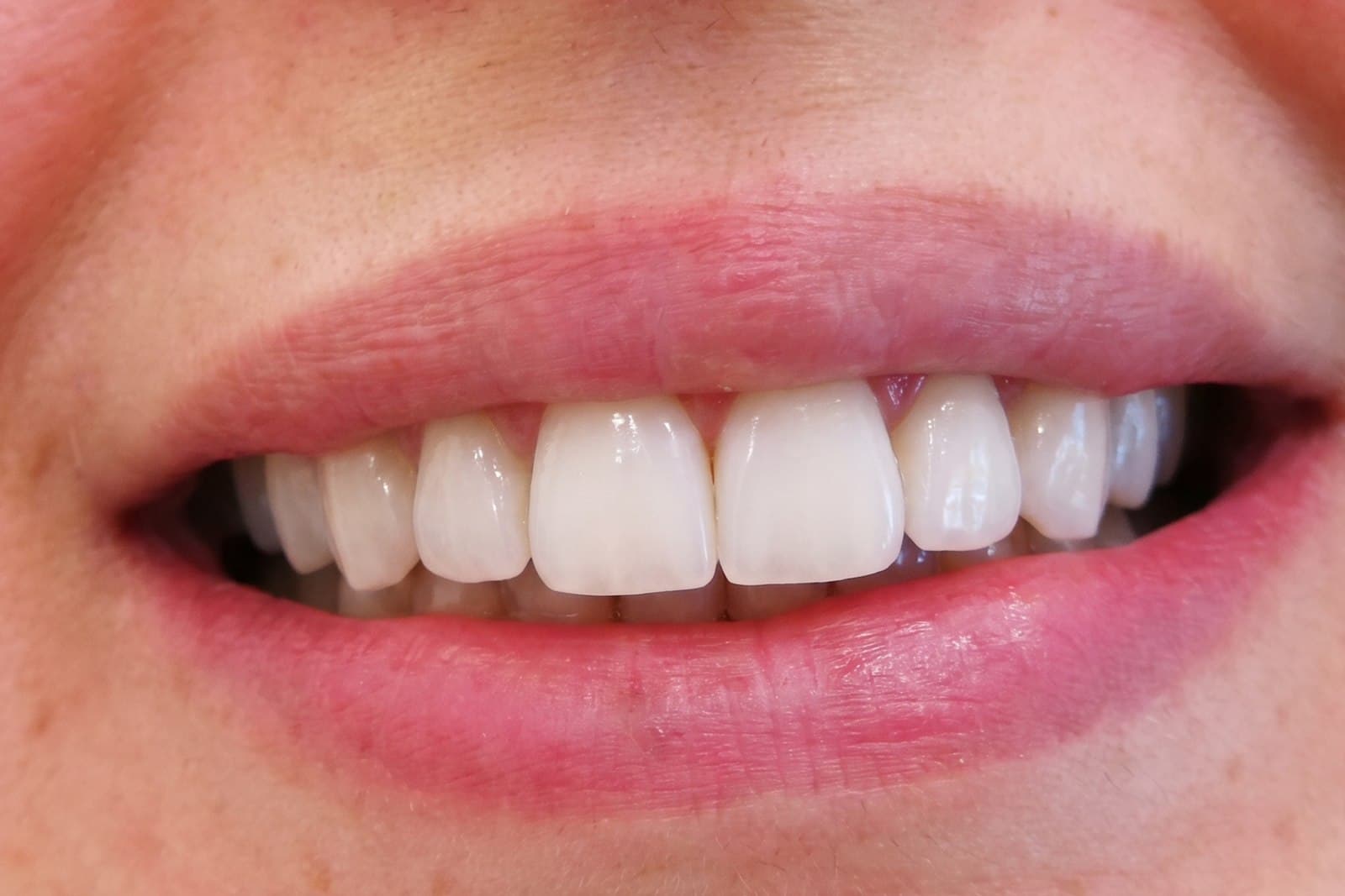 Lo stesso sorriso al termine del trattamento — caso 10
