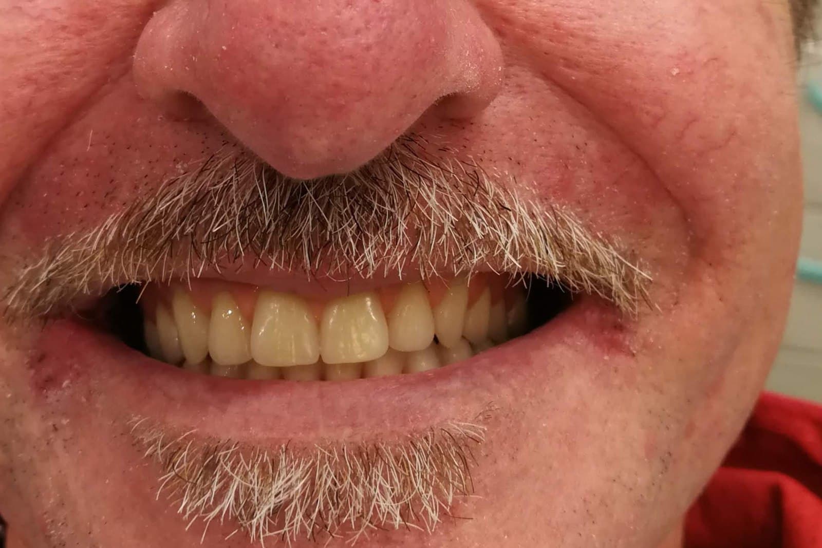 Lo stesso sorriso al termine del trattamento — caso 2