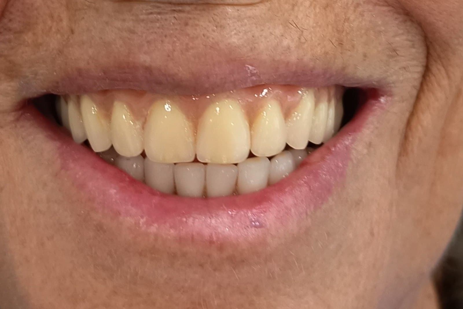 Lo stesso sorriso al termine del trattamento — caso 3