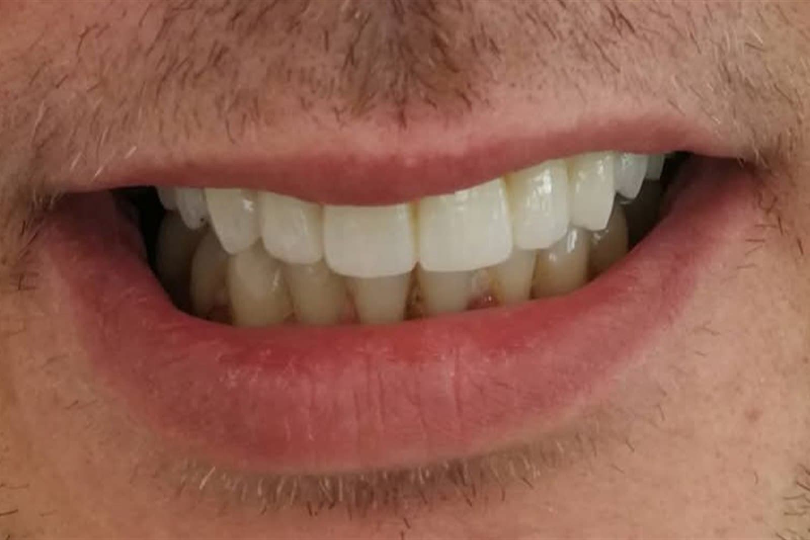 Lo stesso sorriso al termine del trattamento — caso 4