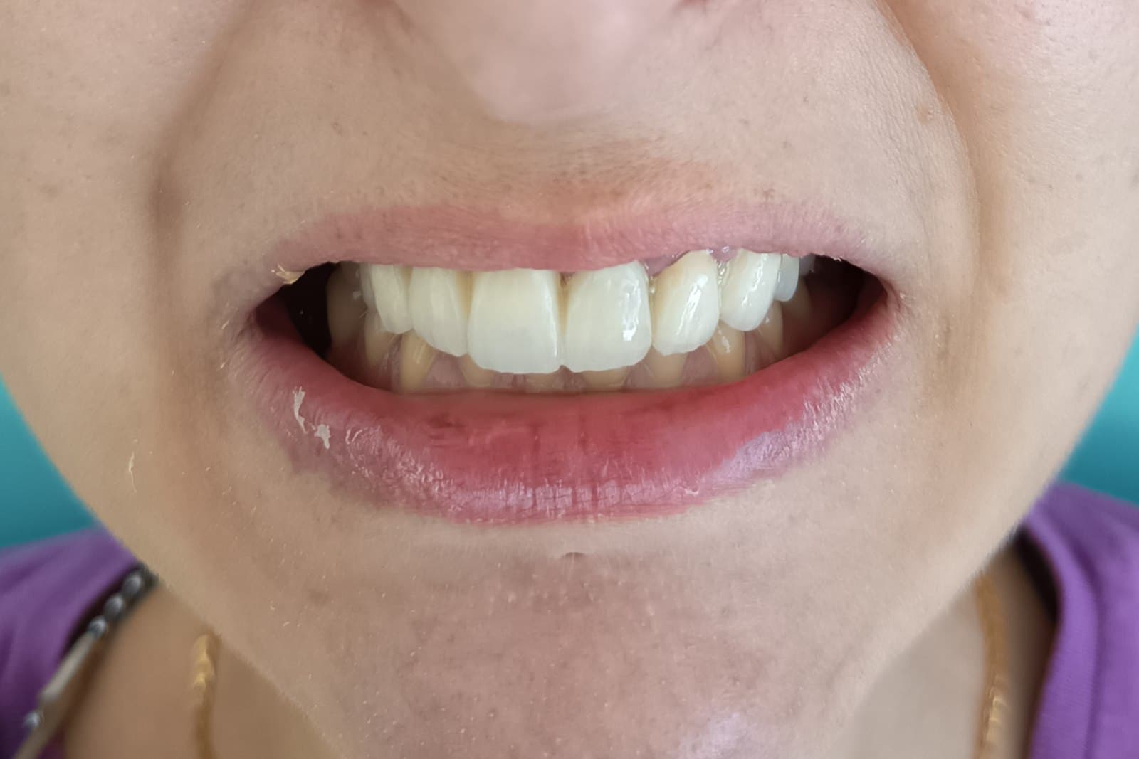 Lo stesso sorriso al termine del trattamento — caso 5