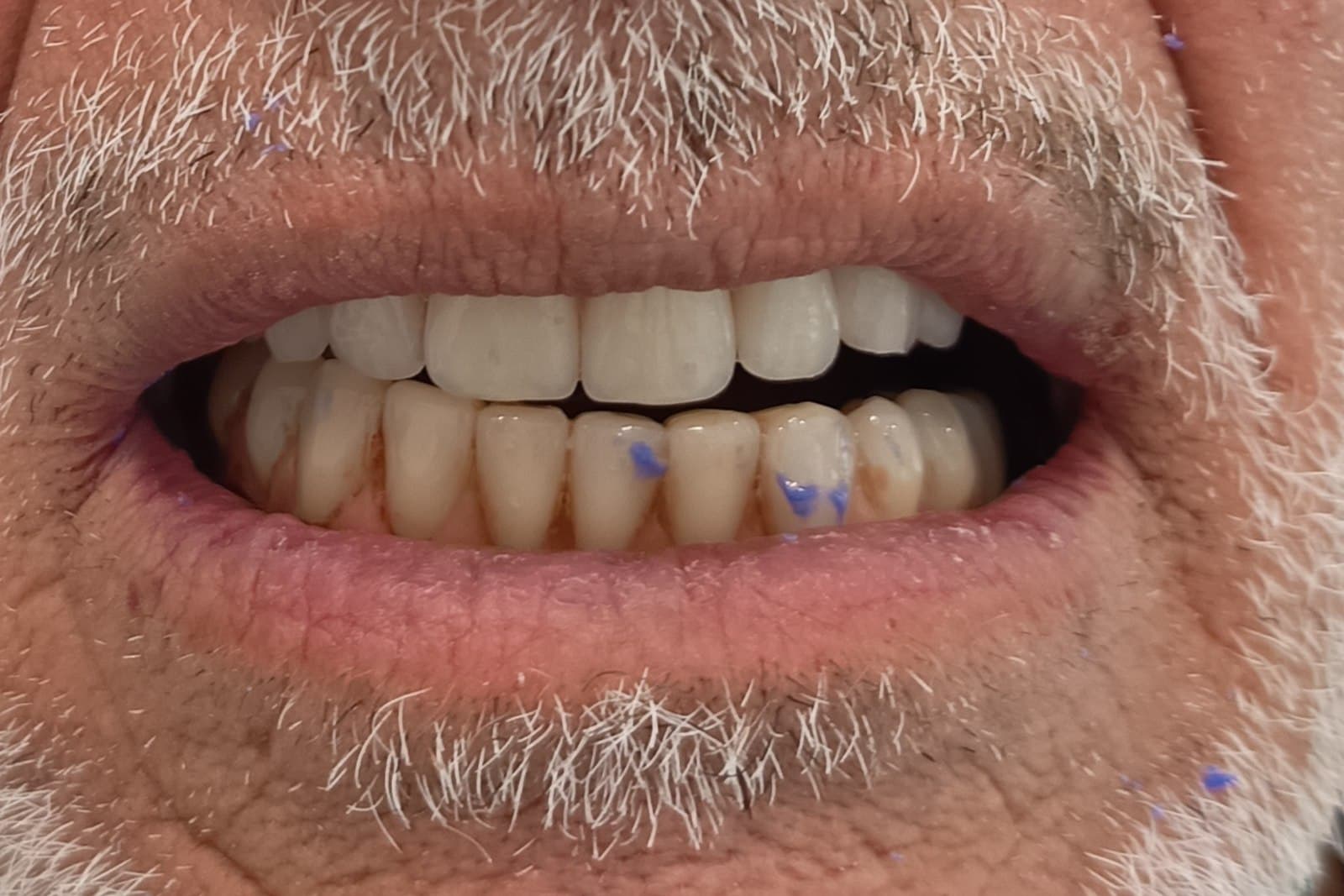 Lo stesso sorriso al termine del trattamento — caso 6
