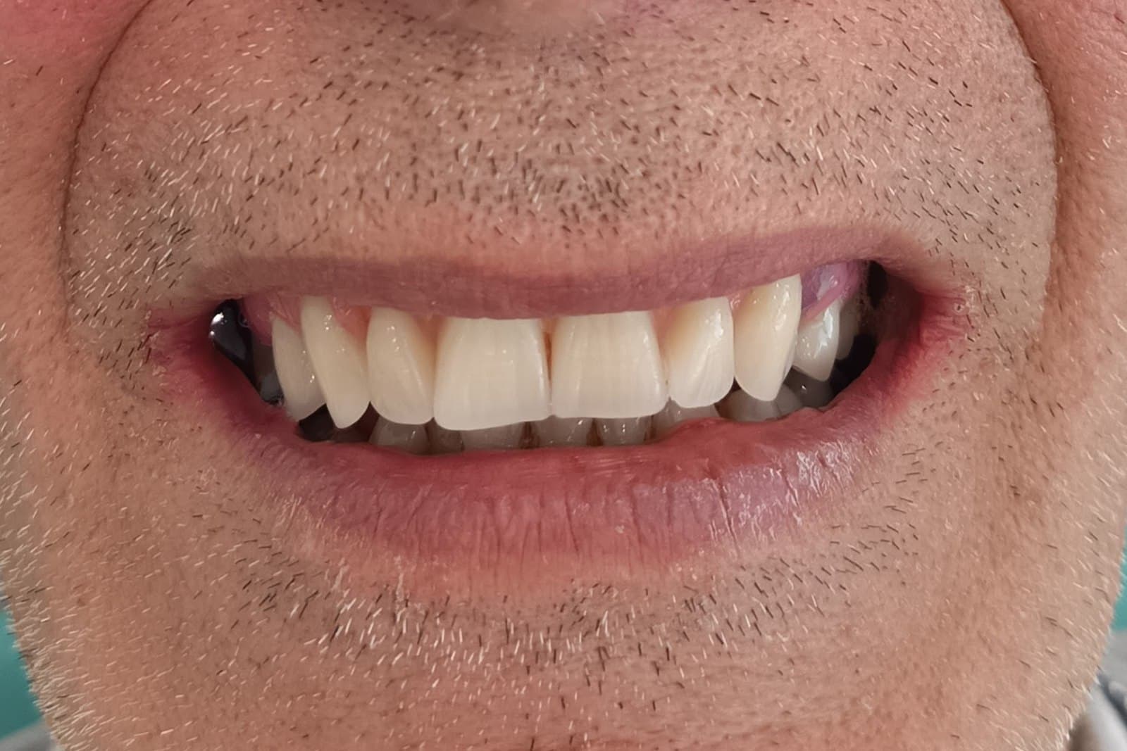 Lo stesso sorriso al termine del trattamento — caso 7