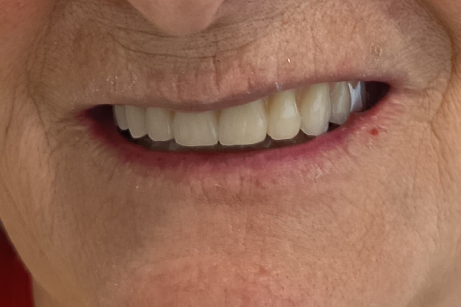 Lo stesso sorriso al termine del trattamento — caso 8