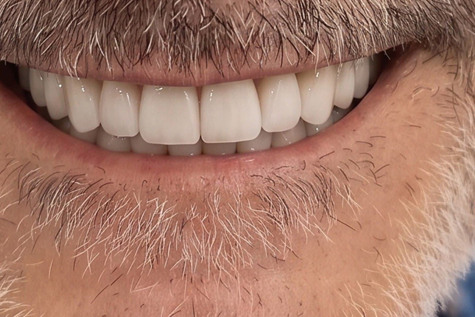 Lo stesso sorriso al termine del trattamento — caso 9