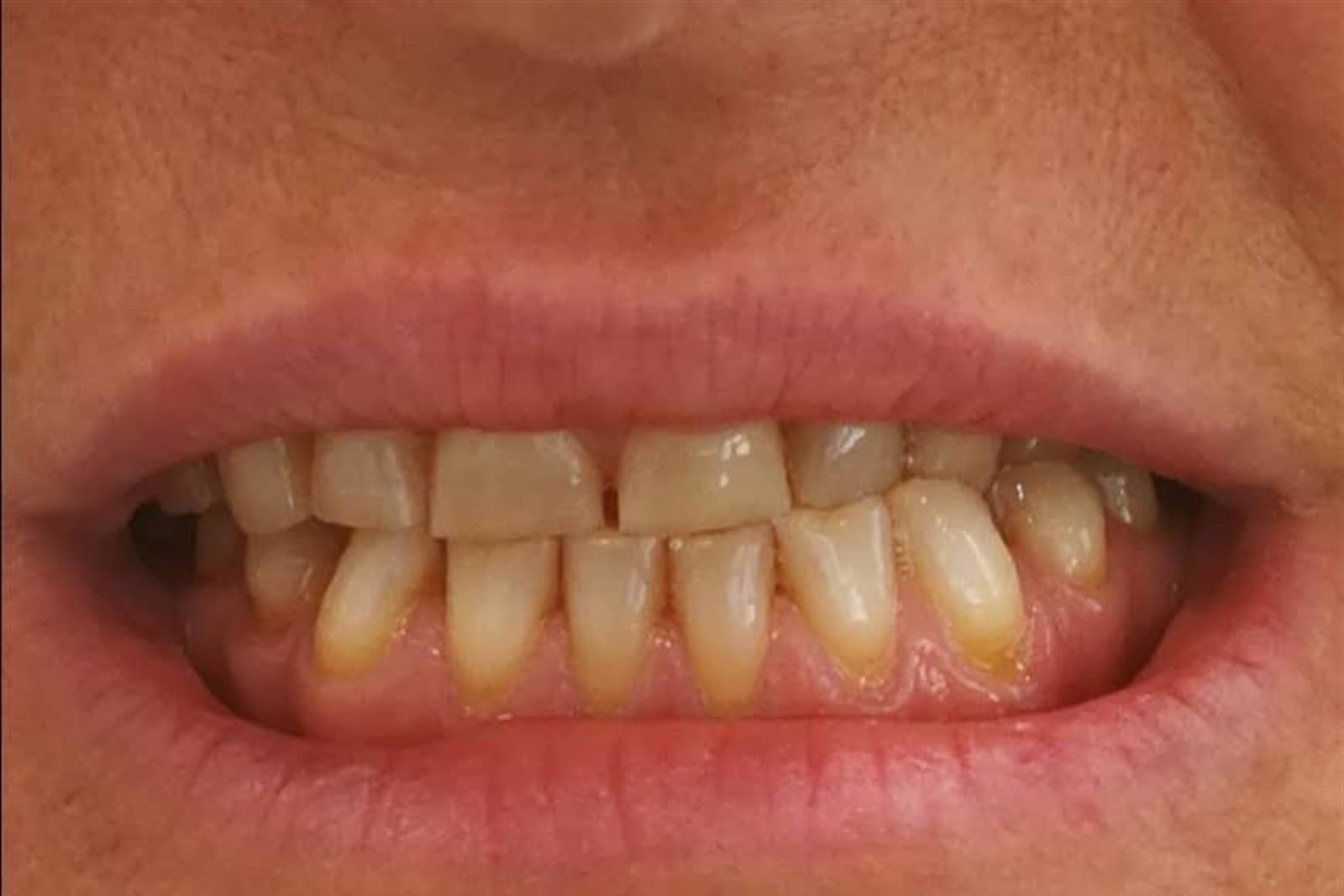 Sorriso del paziente prima del trattamento — caso 1