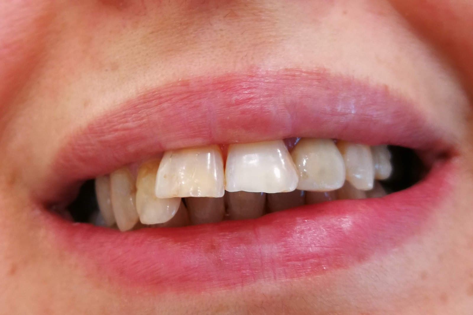 Sorriso del paziente prima del trattamento — caso 10