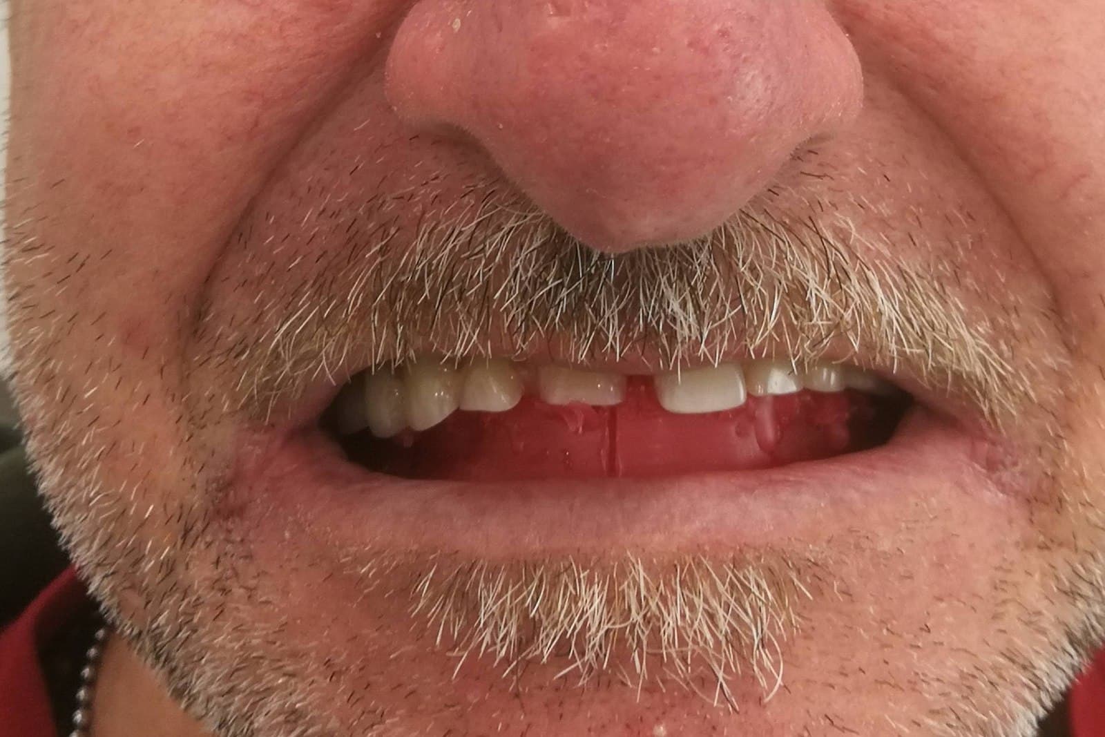 Sorriso del paziente prima del trattamento — caso 2