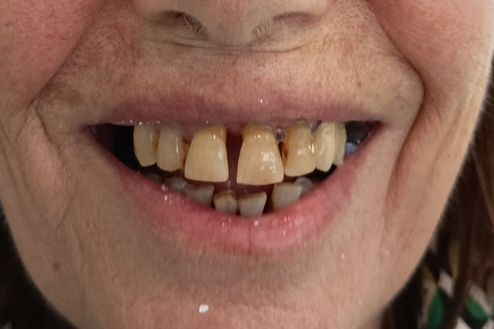 Sorriso del paziente prima del trattamento — caso 3