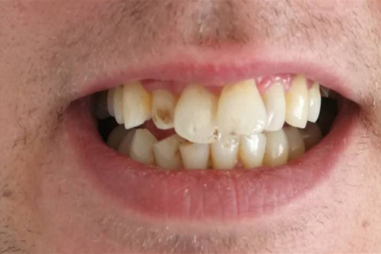 Sorriso del paziente prima del trattamento — caso 4