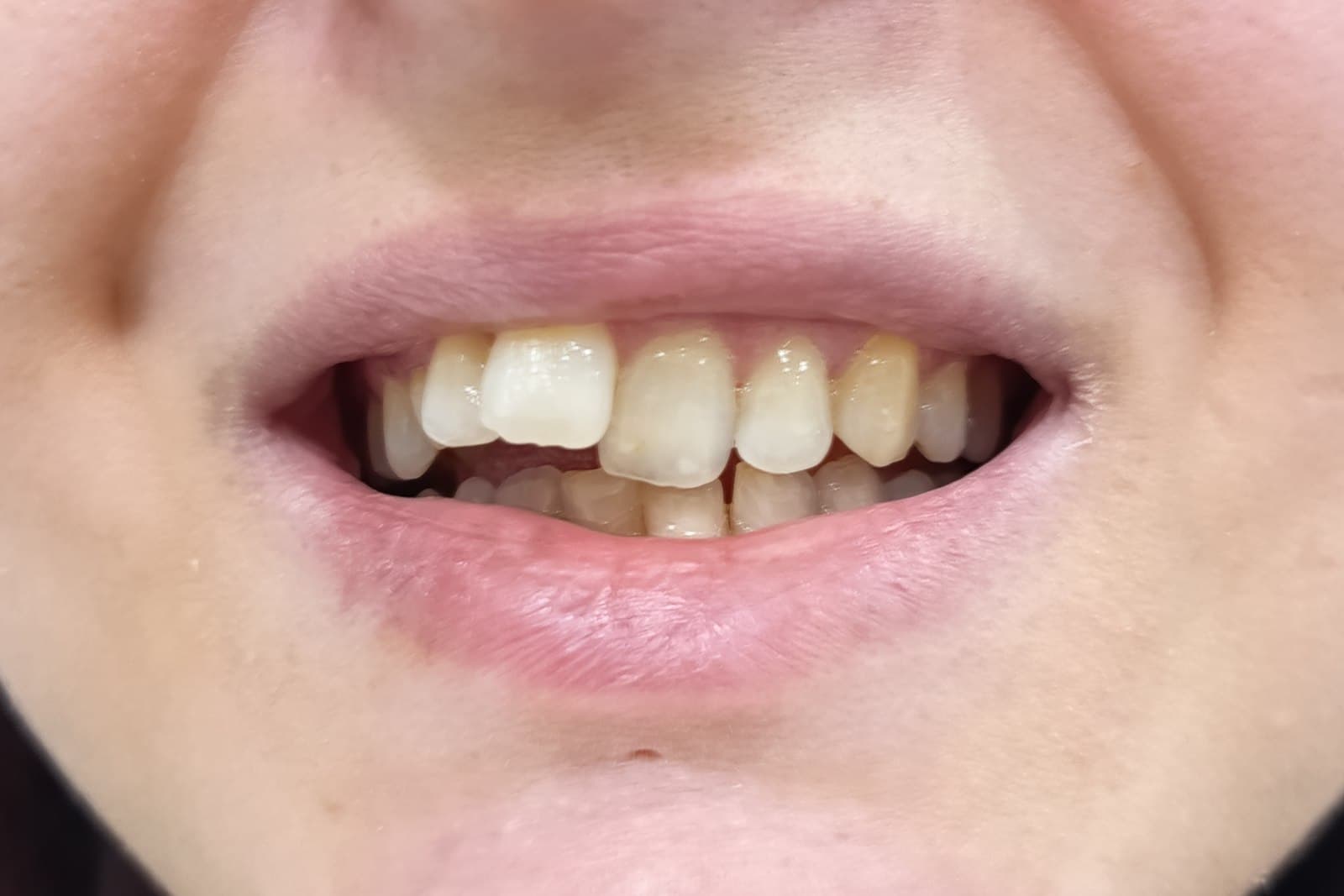 Sorriso del paziente prima del trattamento — caso 5