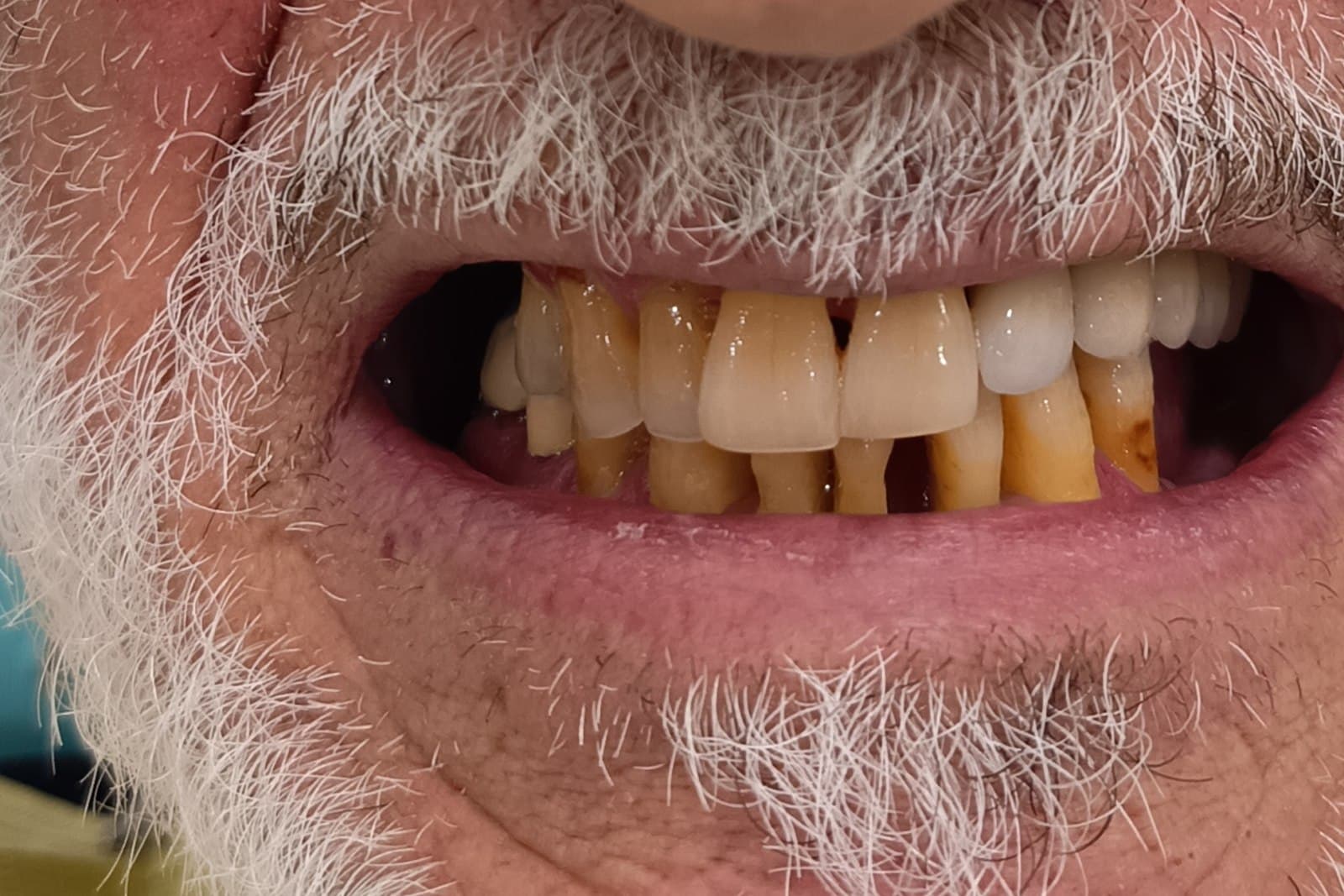 Sorriso del paziente prima del trattamento — caso 6