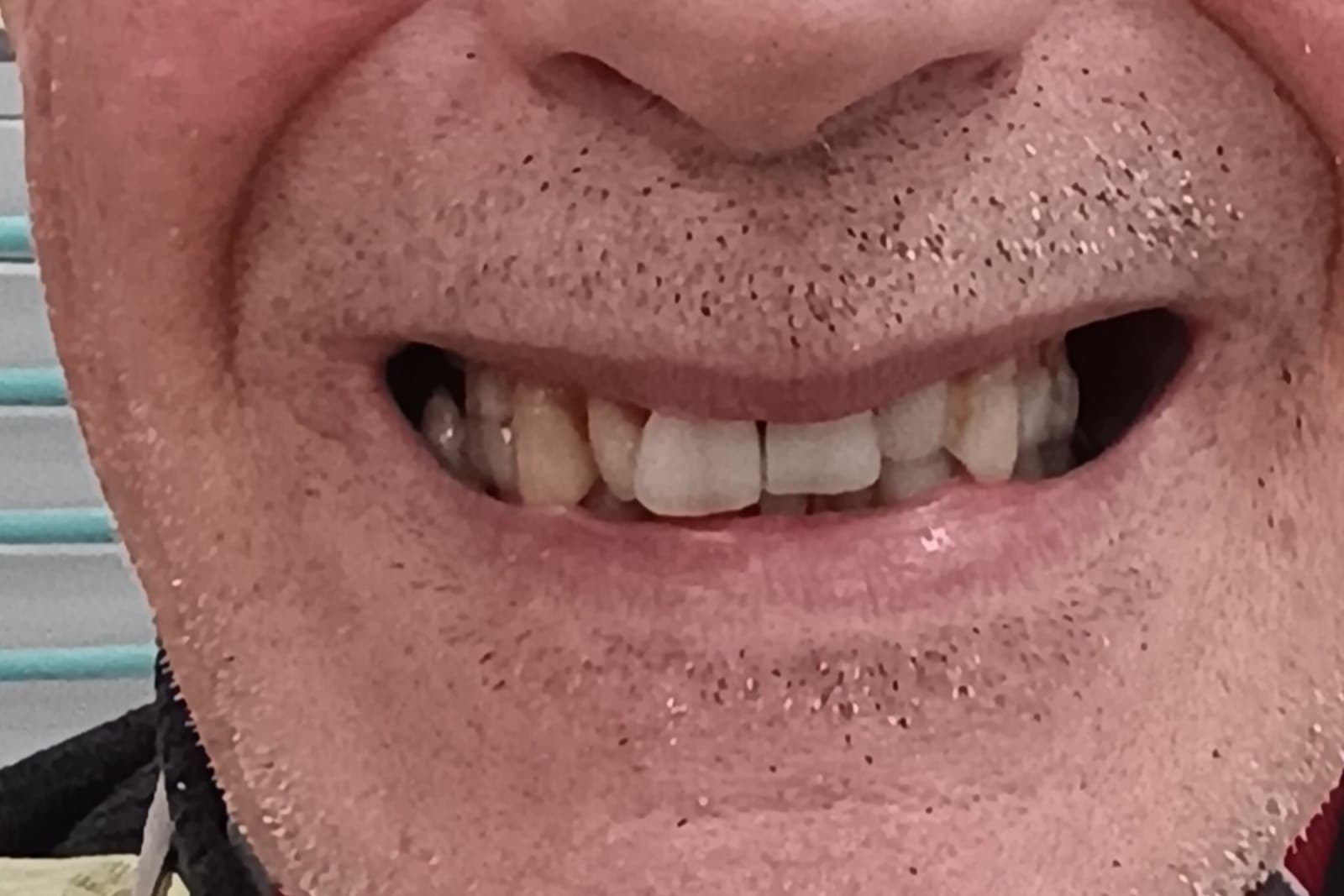 Sorriso del paziente prima del trattamento — caso 7