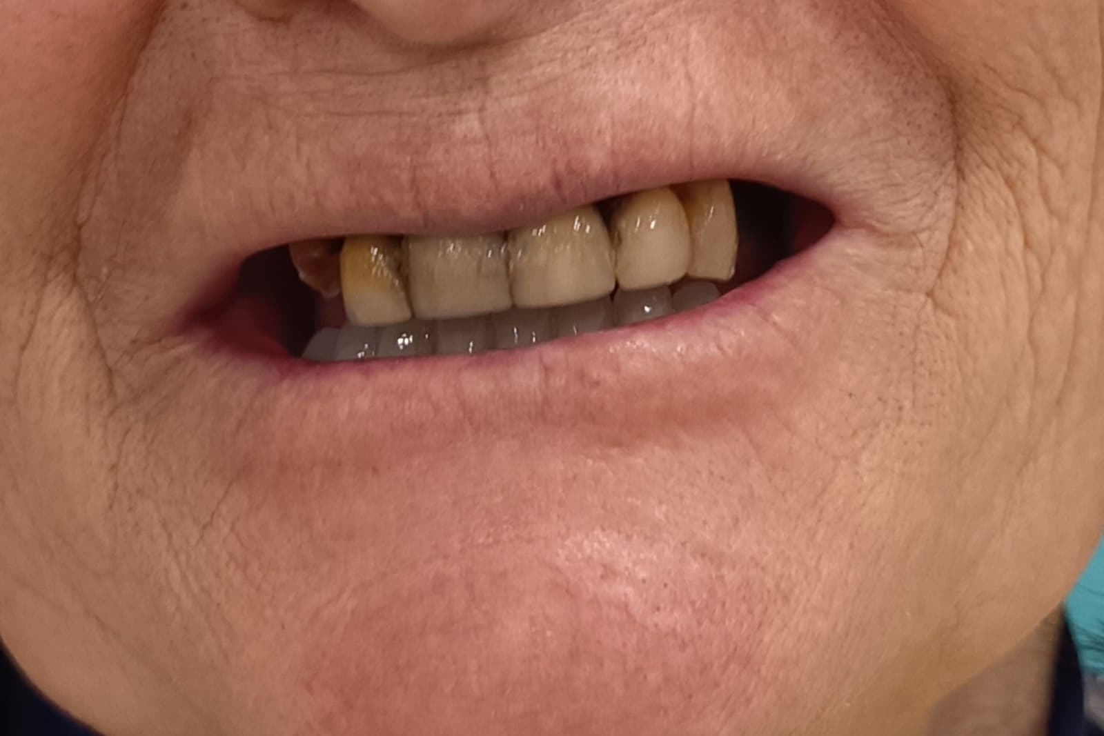 Sorriso del paziente prima del trattamento — caso 8
