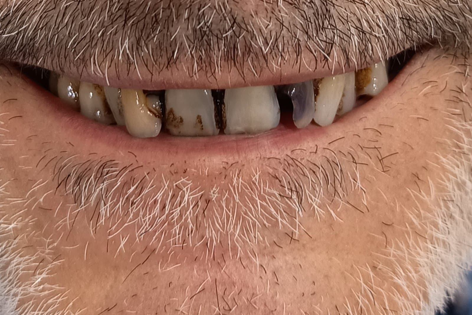 Sorriso del paziente prima del trattamento — caso 9