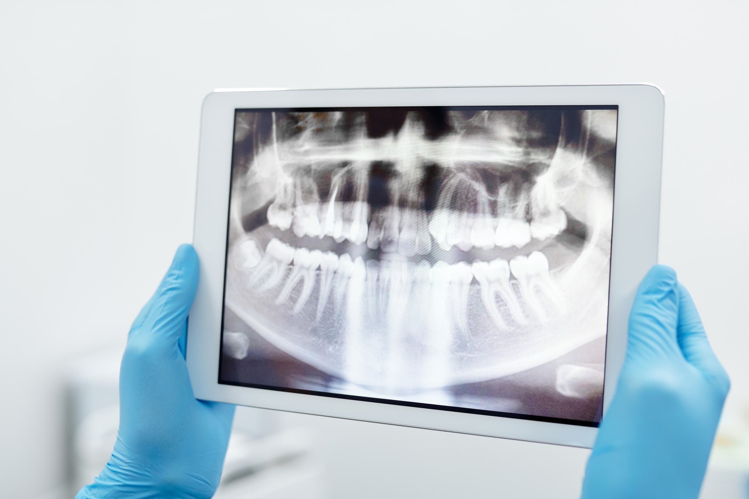 Mani guantate reggono un tablet con la radiografia panoramica di entrambe le arcate